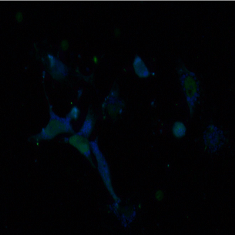 protein aggregation in cancer