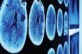 Brain Tumor