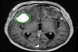 Brain Tumor